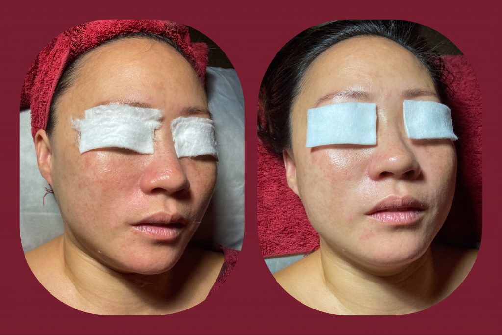 before and after anti aging results