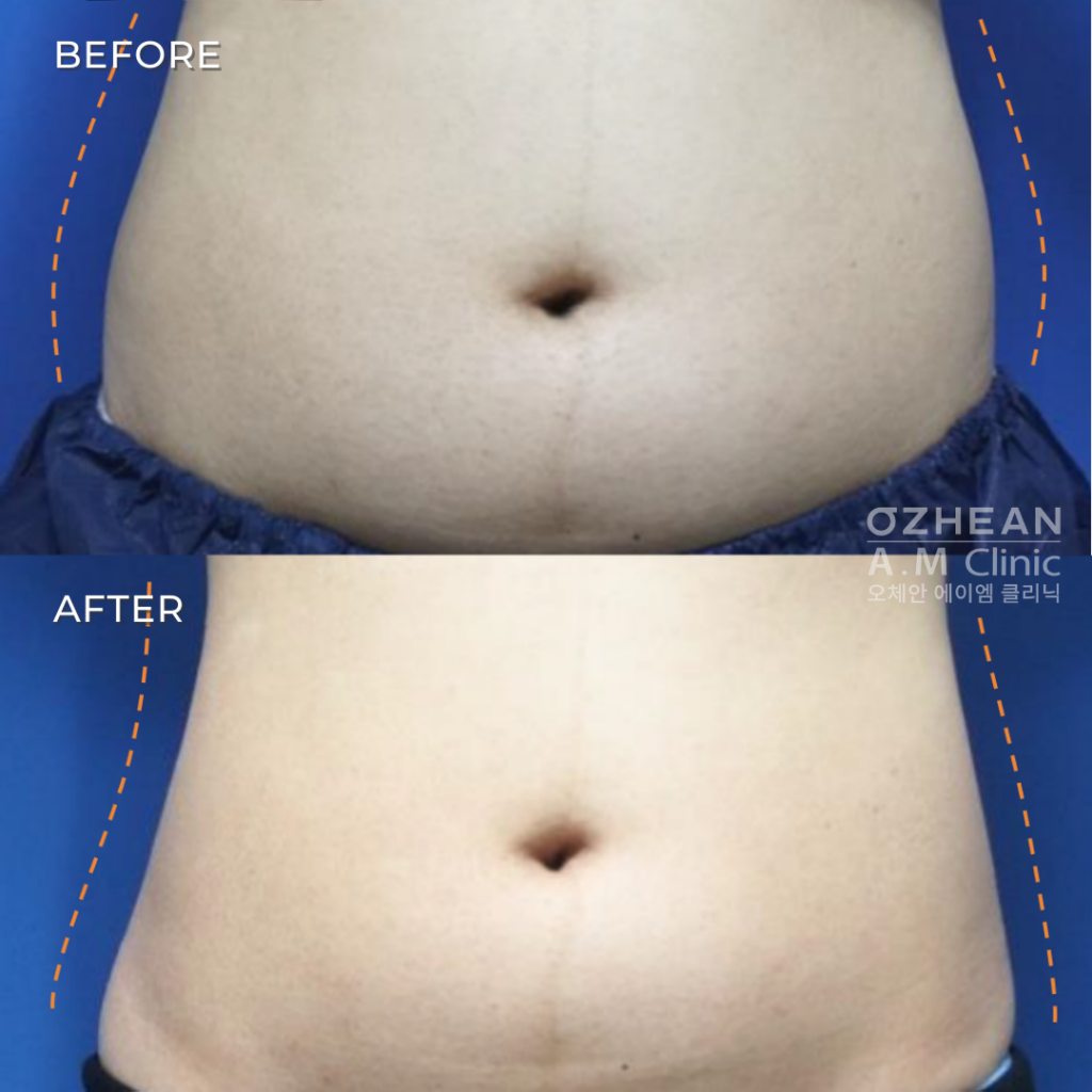 before and after laser lipolysis slimming treatment of abdomen mid section area body shaping slimming treatment with le shape