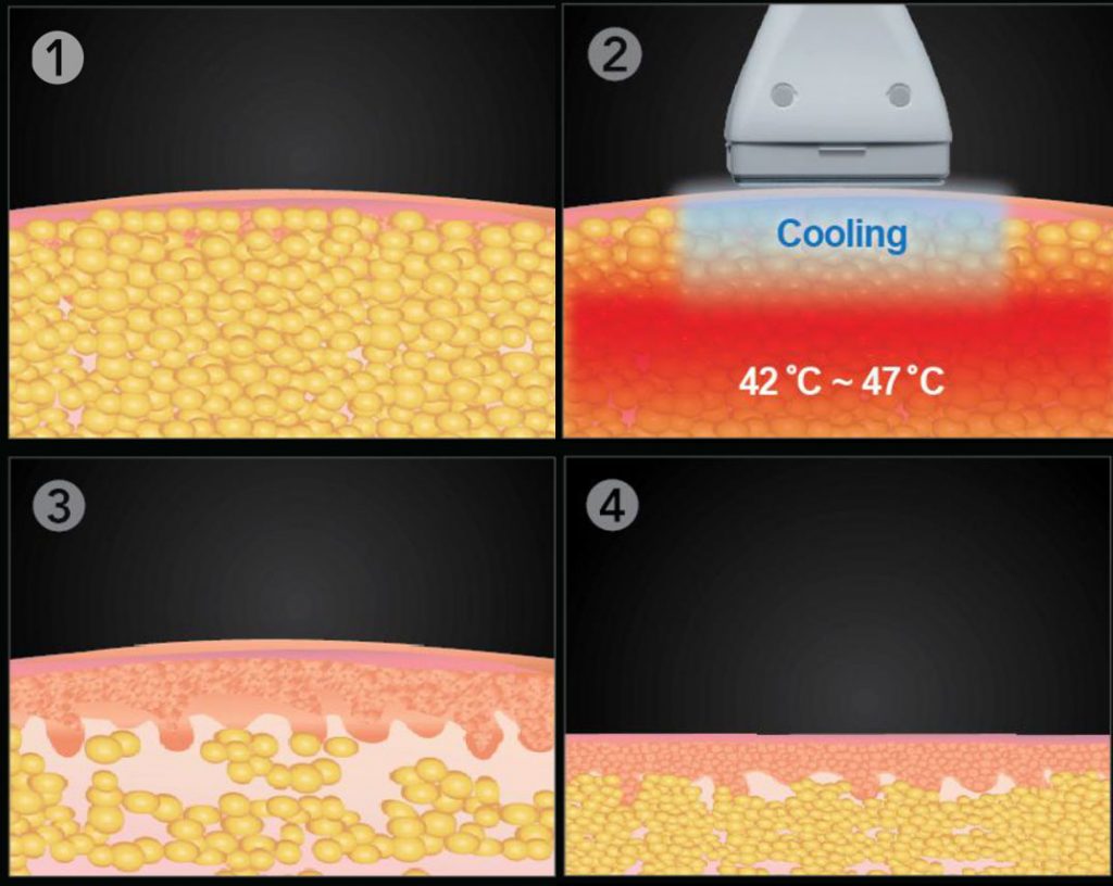 how Le Shape works under the skin