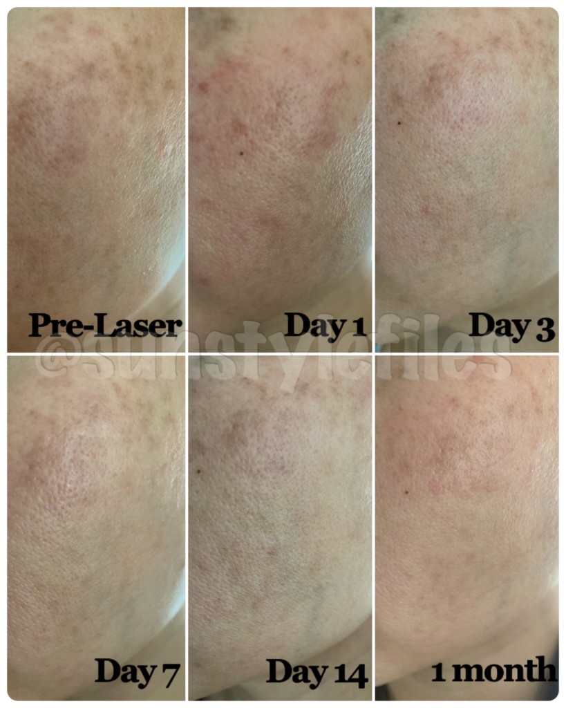 pico laser before and after one month results review on face