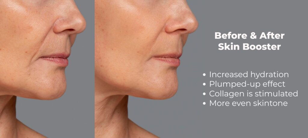 before and after photo results of skin booster injectables
